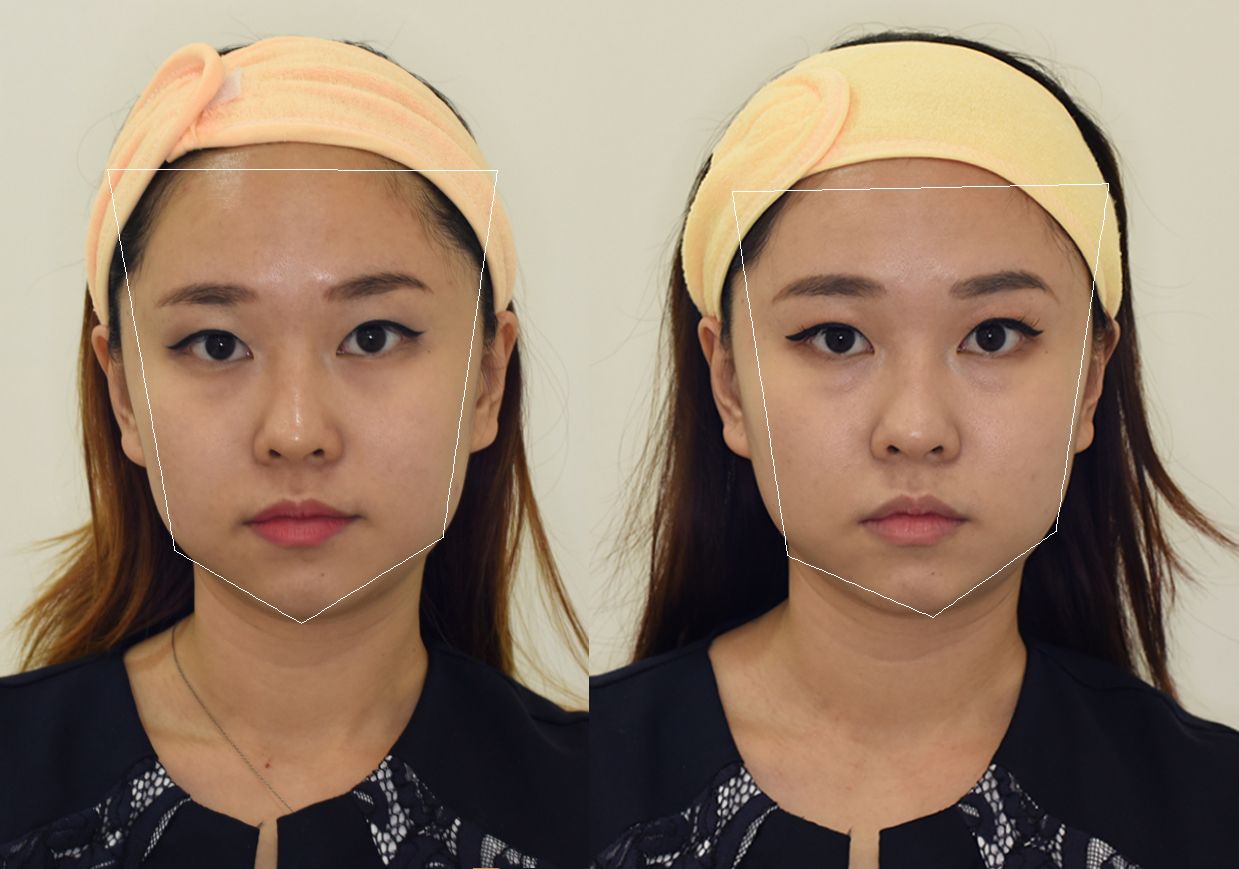  photo Celine Chiam Before After 1.jpg
