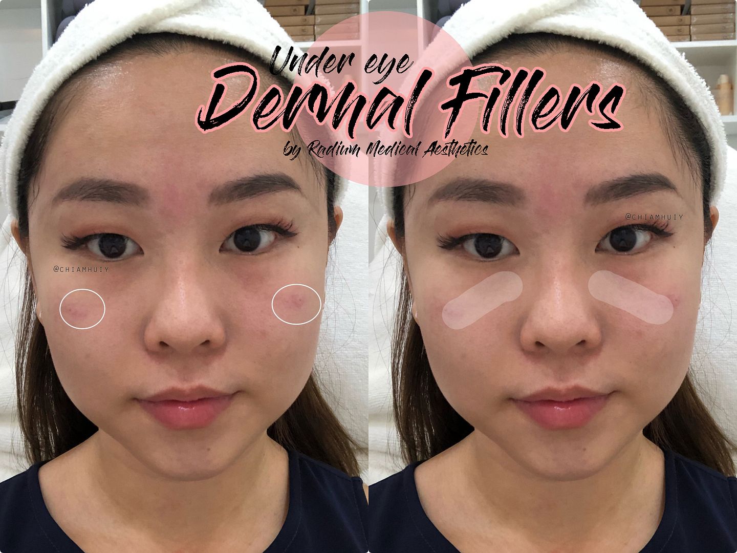 under%20eye%20dermal%20fillers radium%20medical