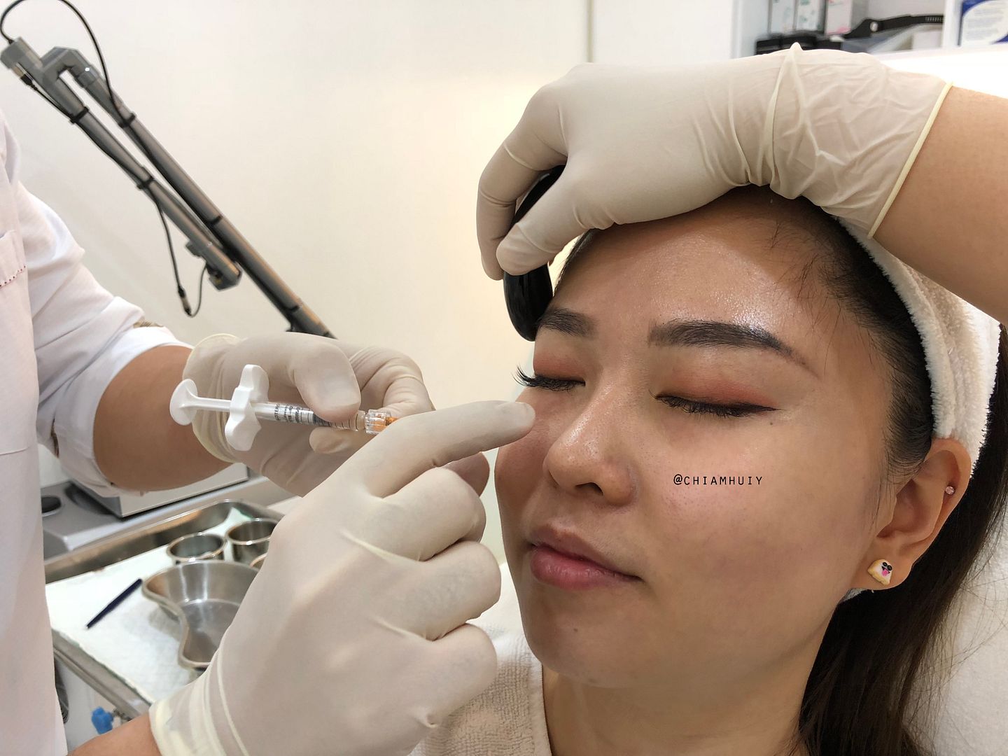 undereye%20dermal%20fillers%20at%20radium%20medial%20clinic2