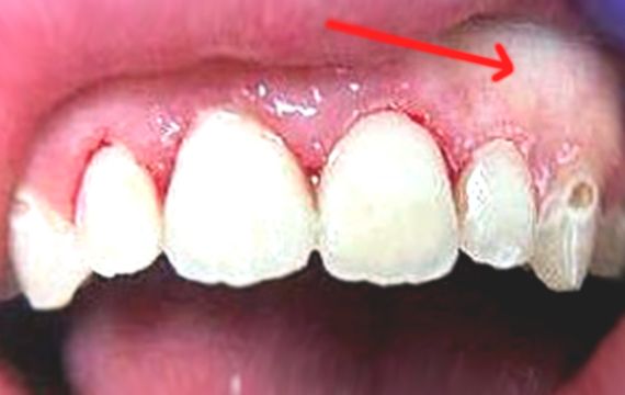 Jenis Gangguan Atau Masalah Pada Gigi dan Mulut