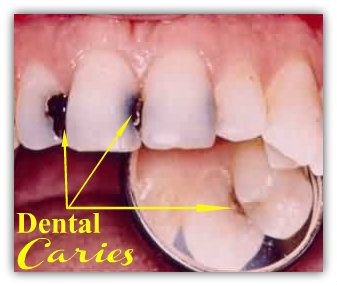 Jenis Gangguan Atau Masalah Pada Gigi dan Mulut
