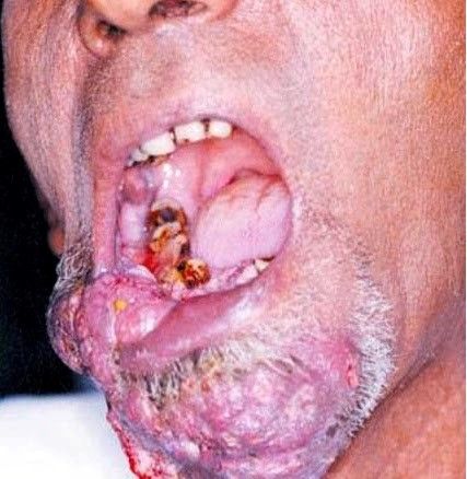 Jenis Gangguan Atau Masalah Pada Gigi dan Mulut