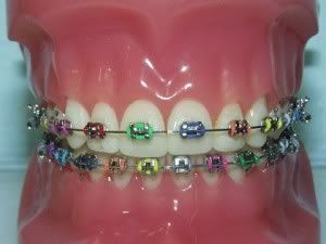 Cost Of Braces For Adults With No Insurance